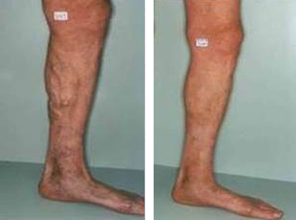 Case 2 – Another case of Calf Varicosities treated by Endovenous Laser