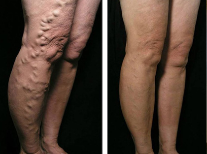 Case 4 – Extensive Varicosities treated by EVLA and Sclerotherapy
