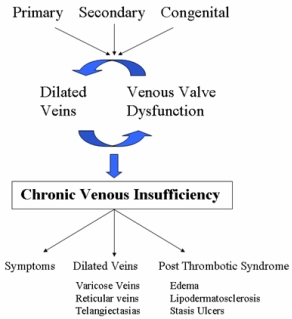 Varicose Vein Disease