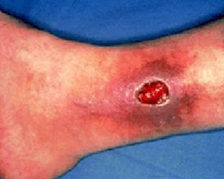 Venous-Ulcer